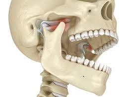 TMJ Dysfunction